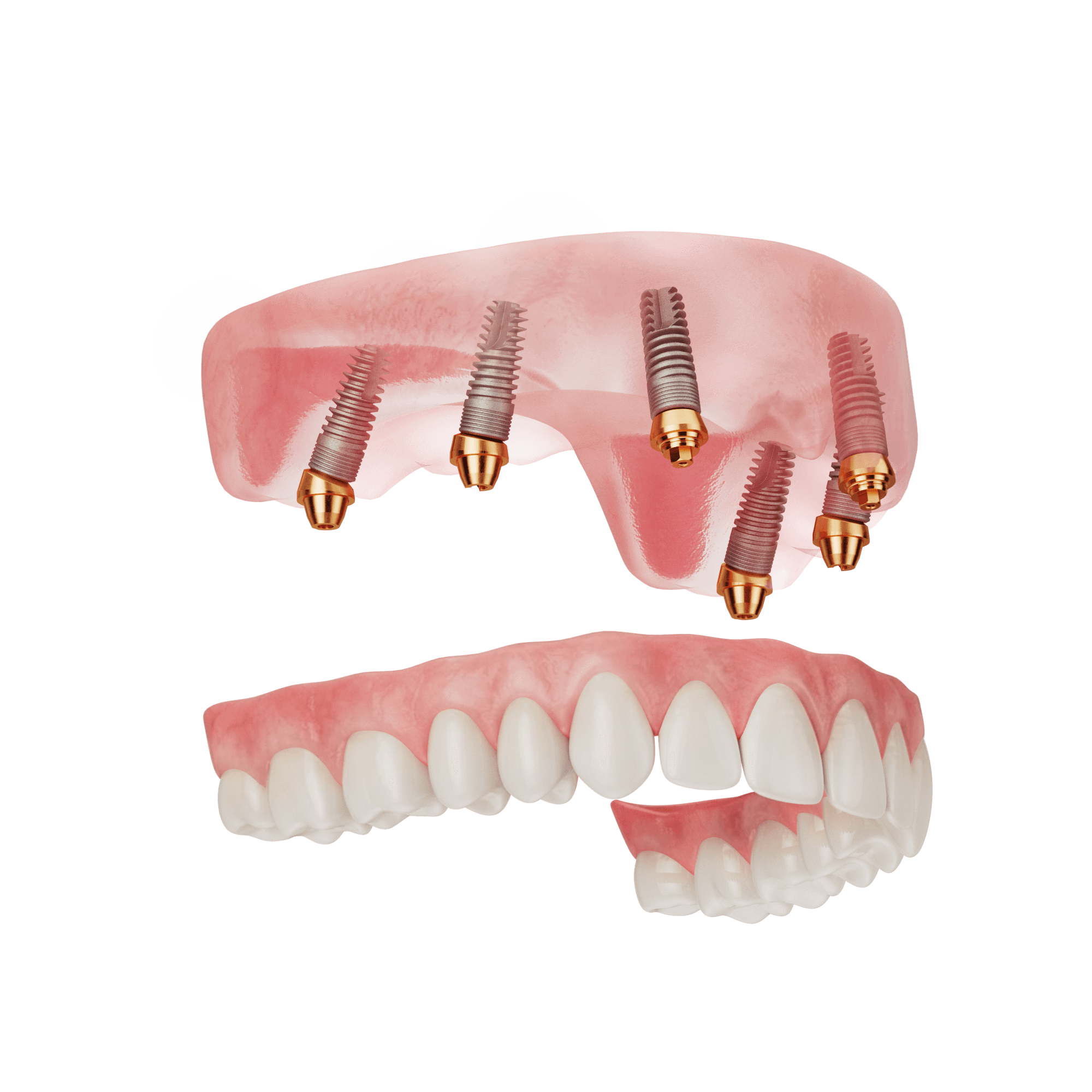 Dual Arch illustration