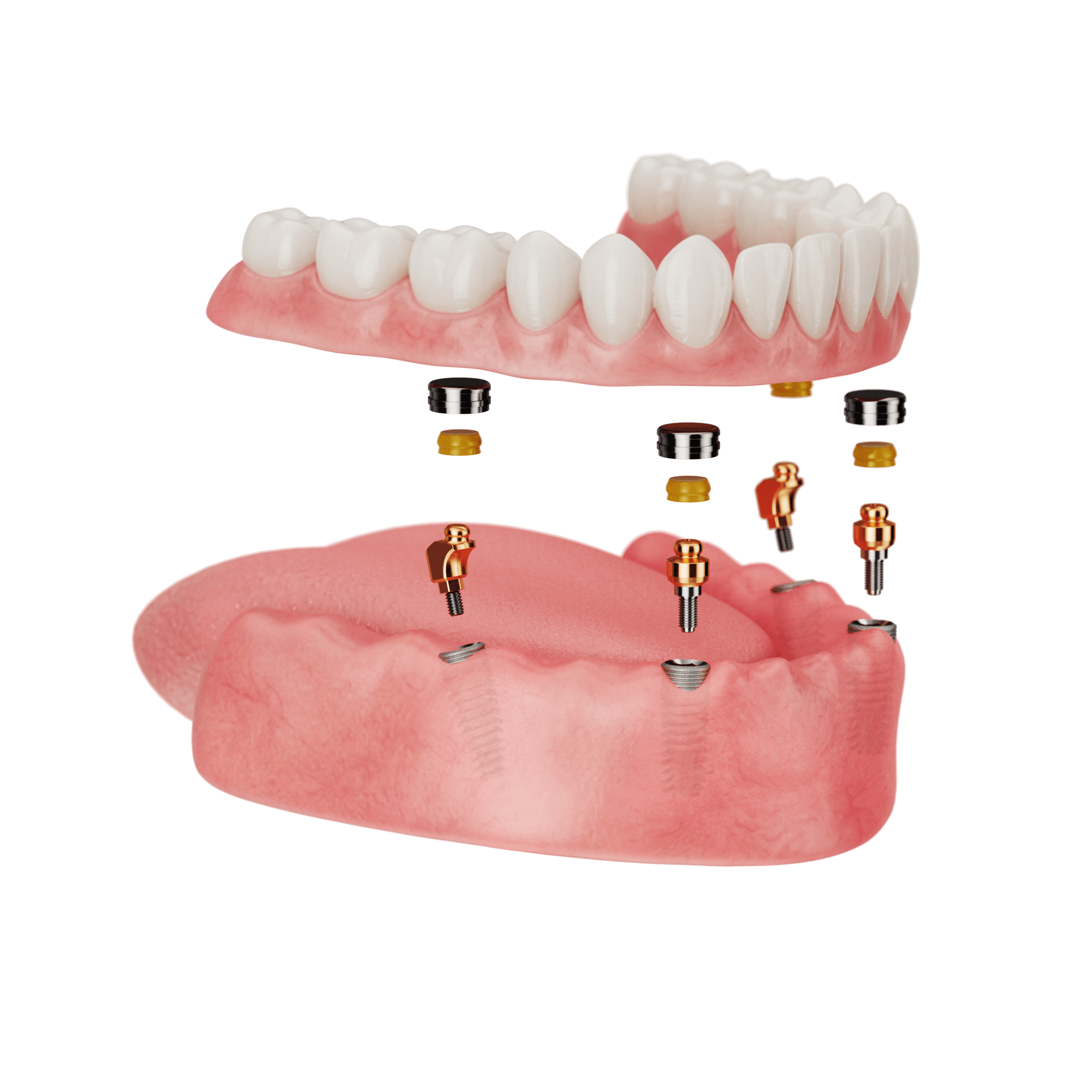 Overdentures illustration